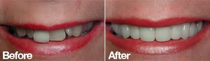 veneers before after turkey